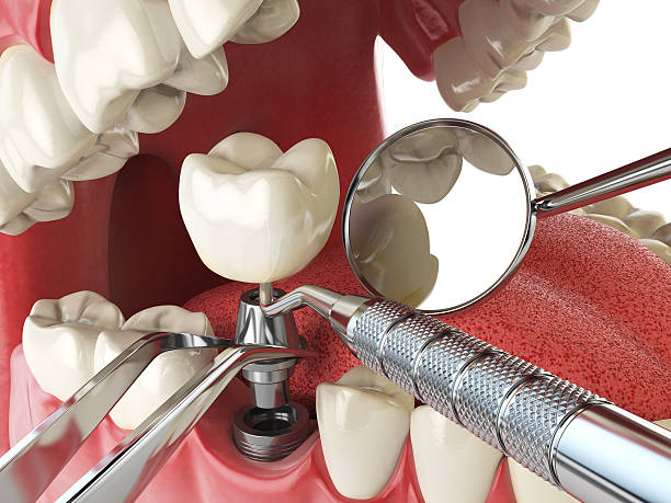 Best Chipped Tooth Repair Near Me  in Loves Park, IL